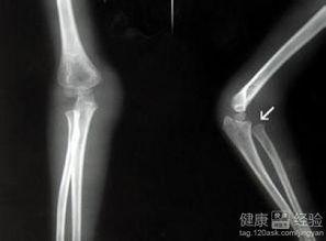 骨折可以吃角瓜,角瓜助力营养补充，加速骨骼愈合